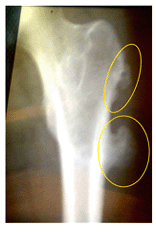 Bone tumors on right femur
